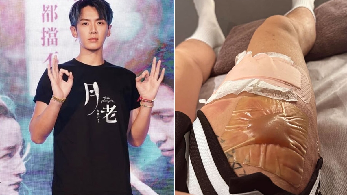 柯震東大腿燙傷「大水泡如水晶餃」!燙傷處理SOP這樣做 人工皮別亂貼