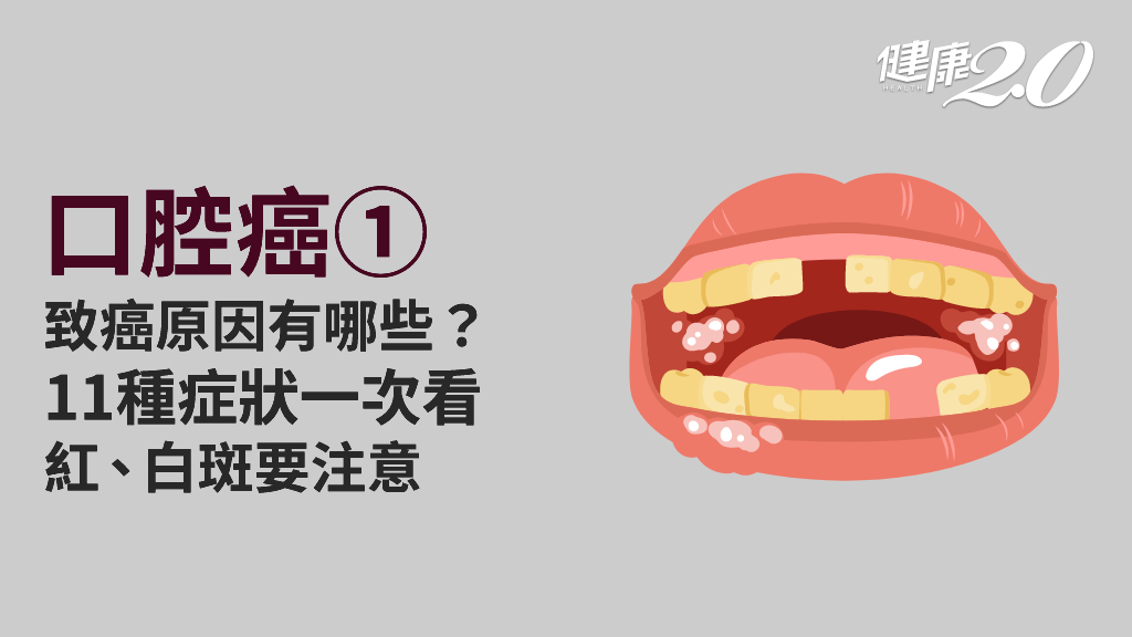 口腔癌／牙齦腫脹、舌頭不靈活 小心口腔癌！11種症狀快就醫 紅斑比白斑更危險