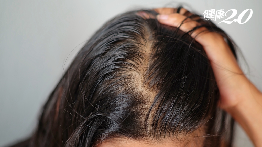 女性缺鐵容易掉髮！補鐵怎麼吃最有效？醫曝1招提升鐵吸收率