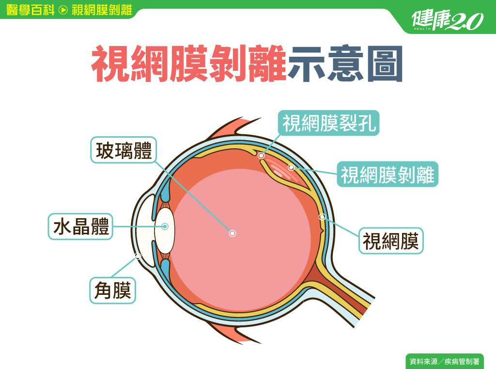 視網膜剝離／閉眼也看見閃光？小心視網膜剝離會失明！3種視網膜剝離這1型最常見