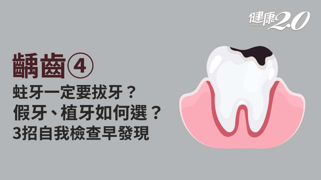 齲齒／蛀牙自我檢查怎麼做？蛀牙治療方法有哪些？假牙、植牙怎麼選？