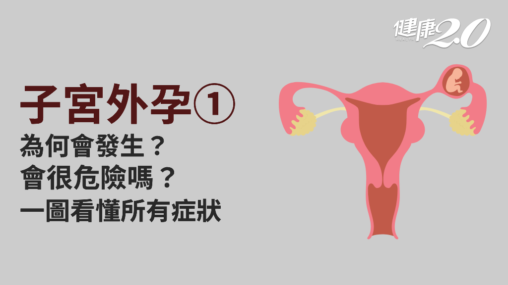 子宮外孕／形成原因有哪些？有哪些症狀？子宮外孕不治療會怎樣？