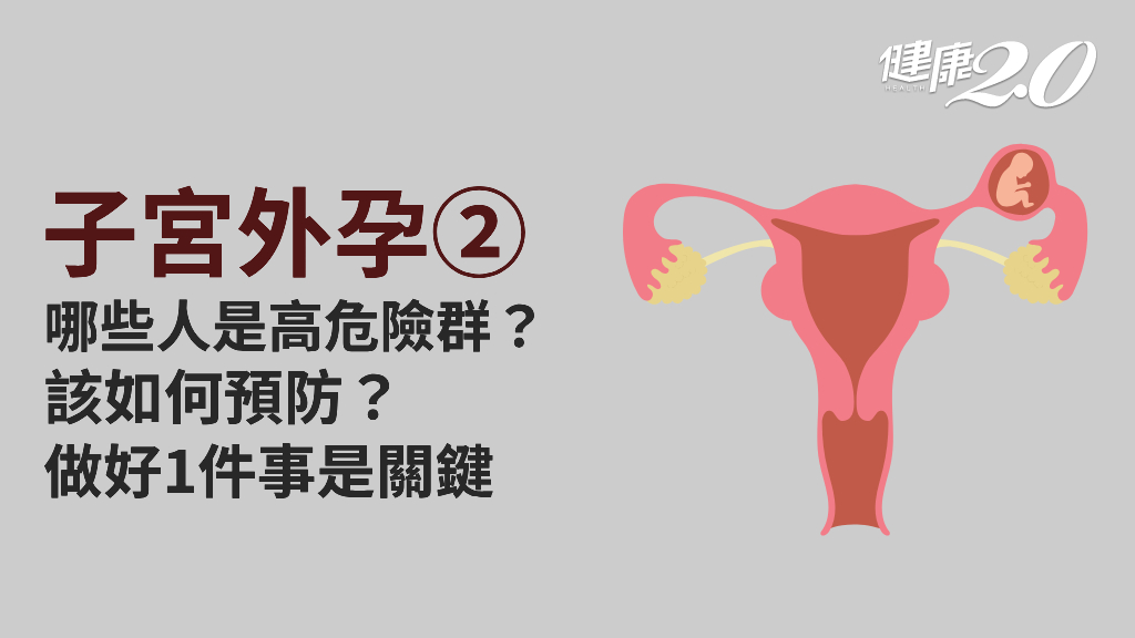 子宮外孕／誰是高危險群？預防子宮外孕的關鍵有哪些？陰道不適別輕忽