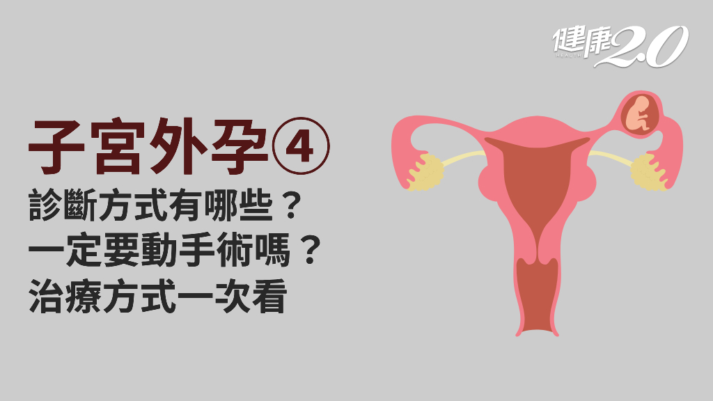 子宮外孕／一定要切除輸卵管嗎？藥物、手術哪個好？治療診斷方法詳解