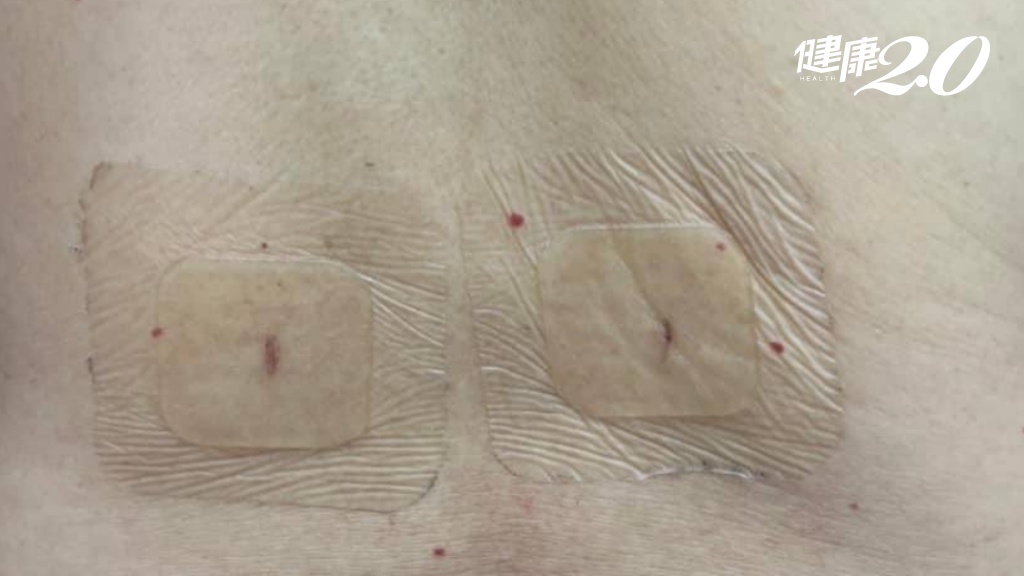 高黏稠骨水泥治療時同樣可以採用微創注射，注射後只有如針孔大的傷口、無需縫線。