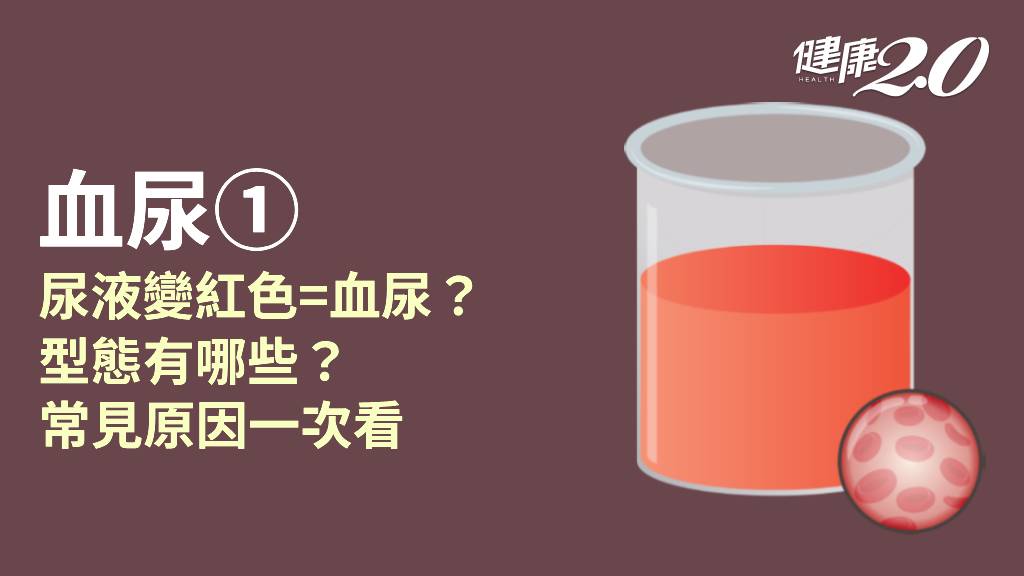 血尿／小便像西瓜汁？為什麼會尿中帶血？5病因搞懂血尿 血尿顏色知多少