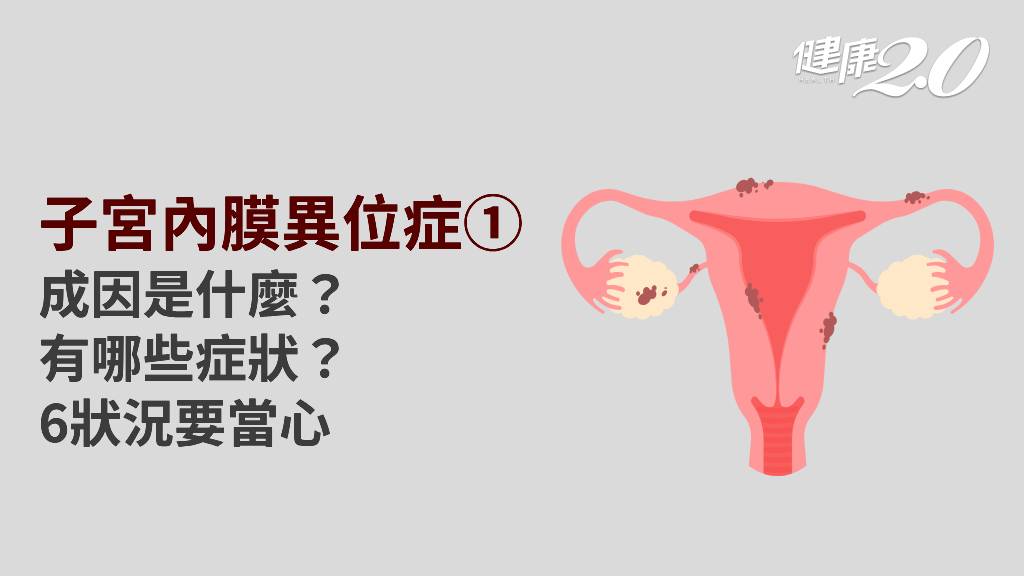 子宮內膜異位症／子宮內膜異位症症狀有哪些？為何會罹病？血尿、經痛當心