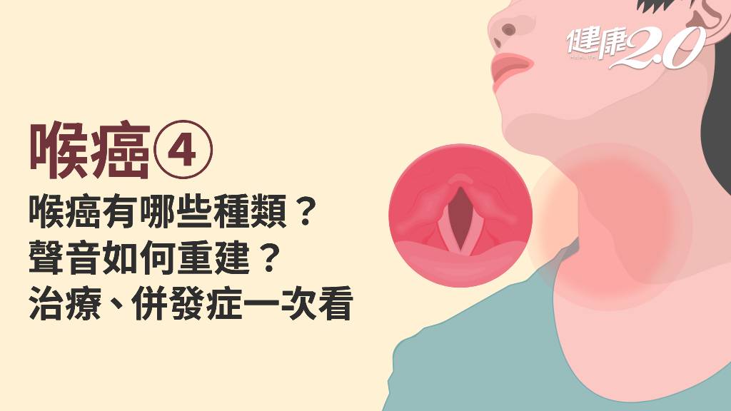 喉癌／喉癌有哪幾種？如何分期？切掉喉嚨聲音如何重建？治療方式全詳解