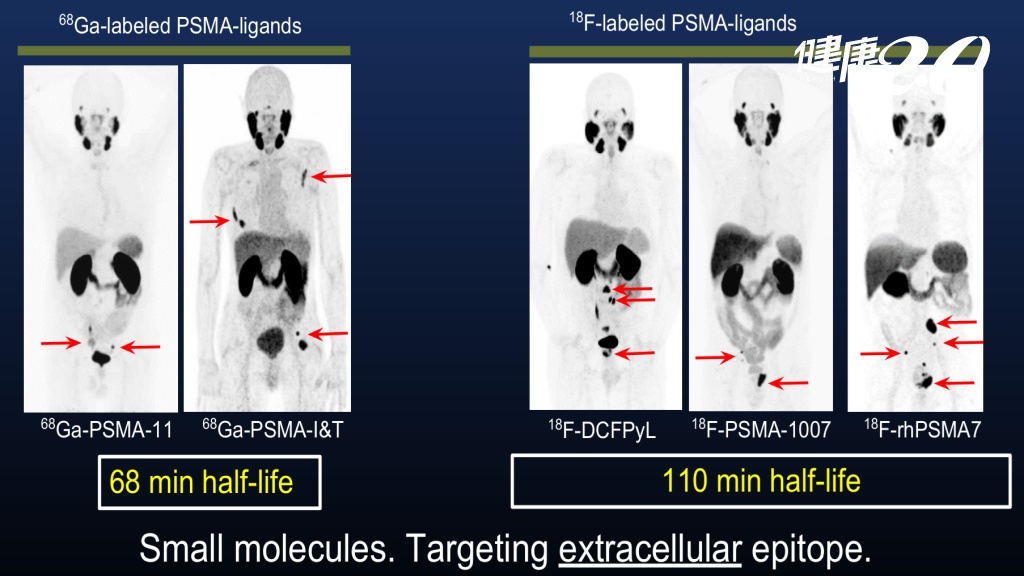 攝護腺腫瘤指數升高卻找不到病灶？放射複合PSMA正子影像來幫忙 精準定位