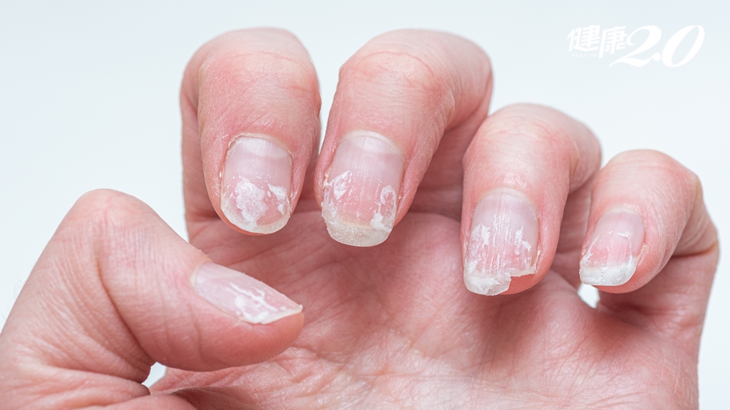指甲變綠和變脆怎麼了？30秒檢查指甲健康 治癒灰指甲這樣做
