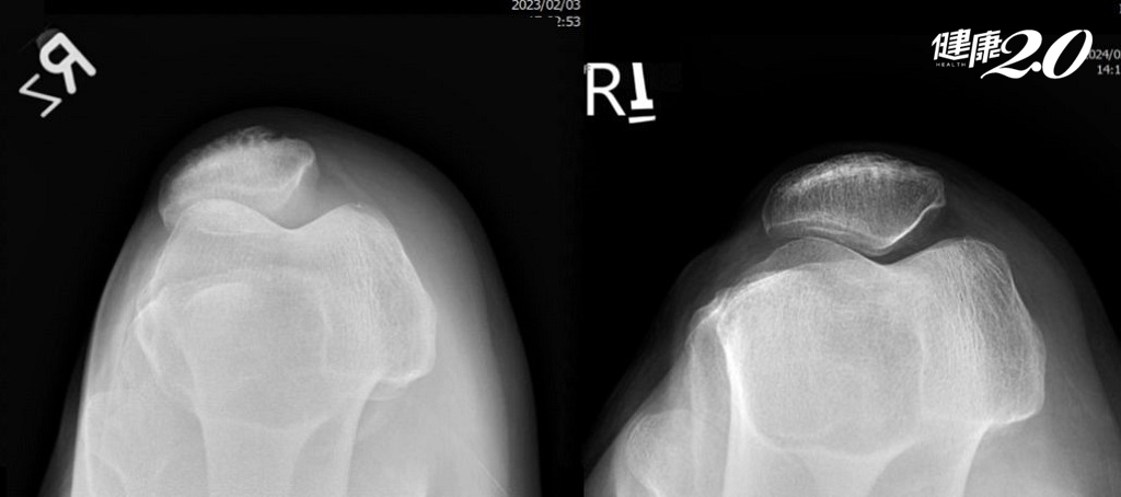 左為術前內側軟骨磨損造成髕骨偏移,右為術後軟骨再生，髕骨矯正回來 - 複製