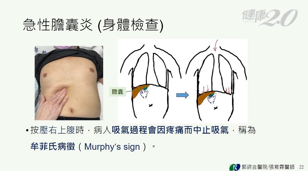 急性膽囊炎 身體檢查