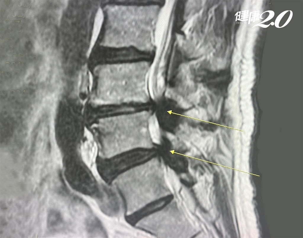 ▲患者脊椎狹窄情形。（圖片／澄清醫院中港分院提供）