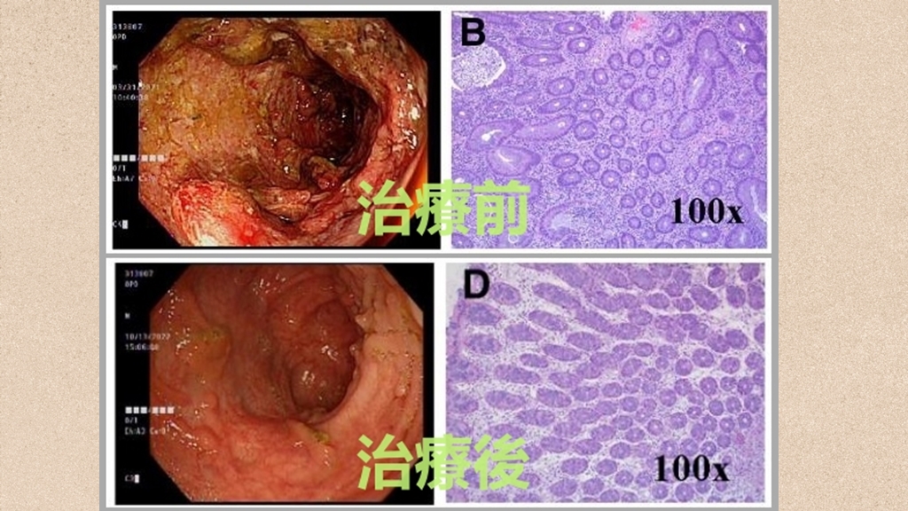 潰瘍性結腸炎中西醫合併治療前後對照圖，患者腸黏膜變完整（左）、細胞排列變整齊。