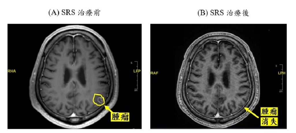 SRS治療