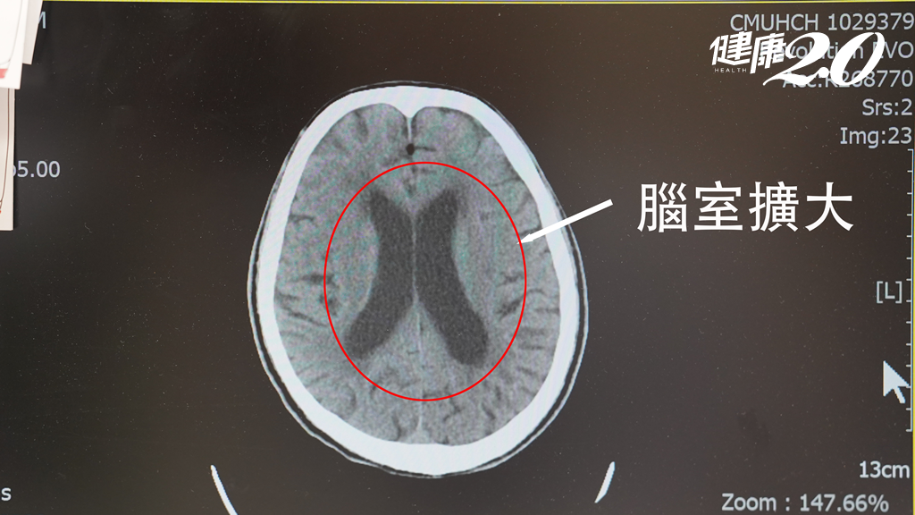 男走路不穩還尿失禁竟是腦內「這東西」過多 術後就改善