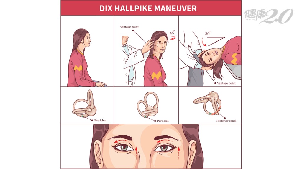 ▲Dix-Hallpike測試有助於醫師診斷是否為耳石脫落。(圖片/達志影像/shutterstock提供) ▲Dix-Hallpike測試有助於醫師診斷是否為耳石脫落。(圖片/達志影像/shutterstock提供)