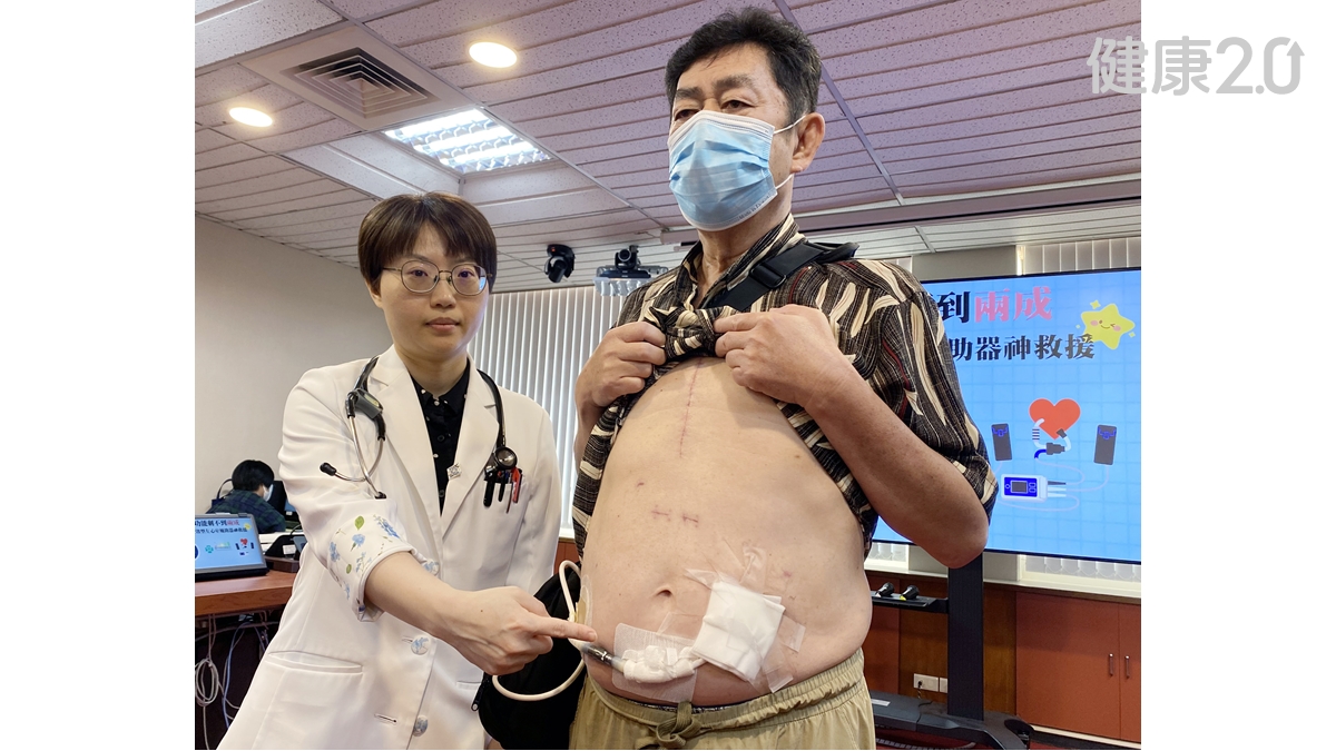 心衰竭男1年住院3次 靠「續命神器」等換心