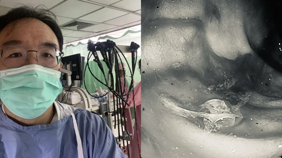 80歲阿公狂瀉1000c.c.鮮血!腸內「黑血+鮮血」醫師一照驚呆:兇手是這碗湯