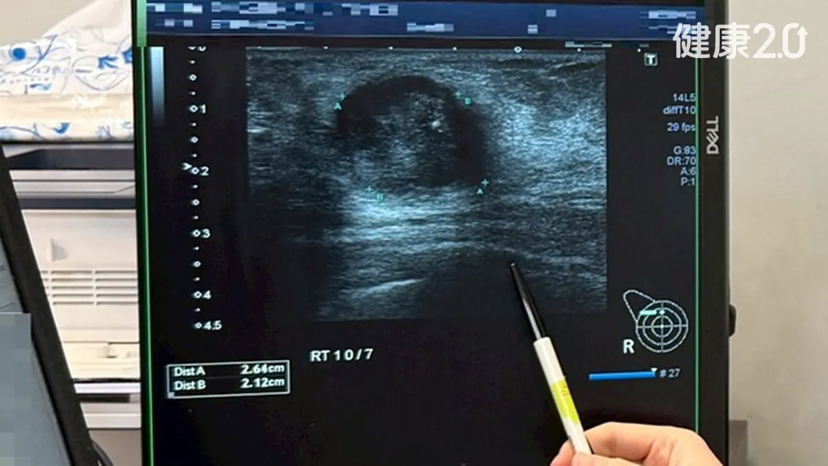 乳房腫塊十年-ignore家族史仍需定期檢查